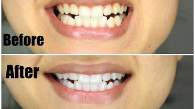 Trial Pack Teeth Whitening Strips