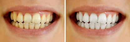 Trial Pack Teeth Whitening Strips