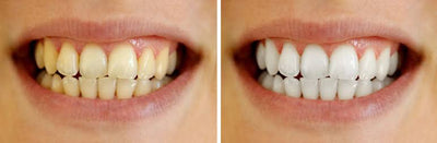 Trial Pack Teeth Whitening Strips